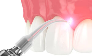 Laser Dental Treatment - Brite Smile Dental