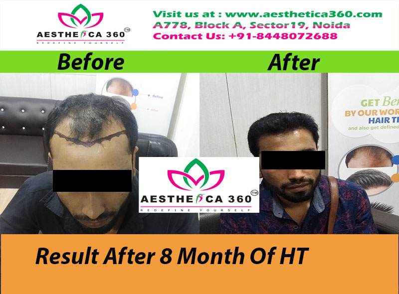 Best Hair Transplant & Hair Treatment Clinic Noida & Greater Noida