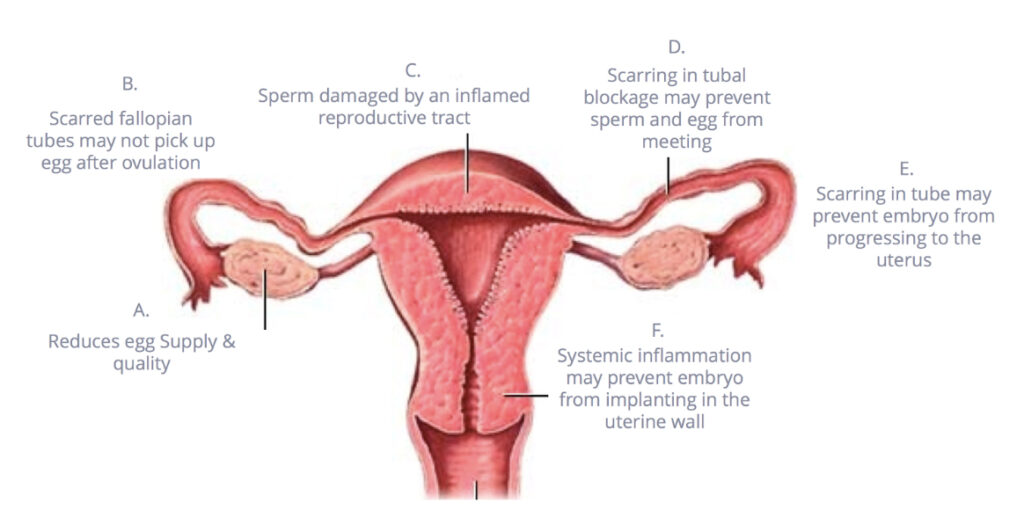 Exploring the Origins: What Causes Endometriosis?