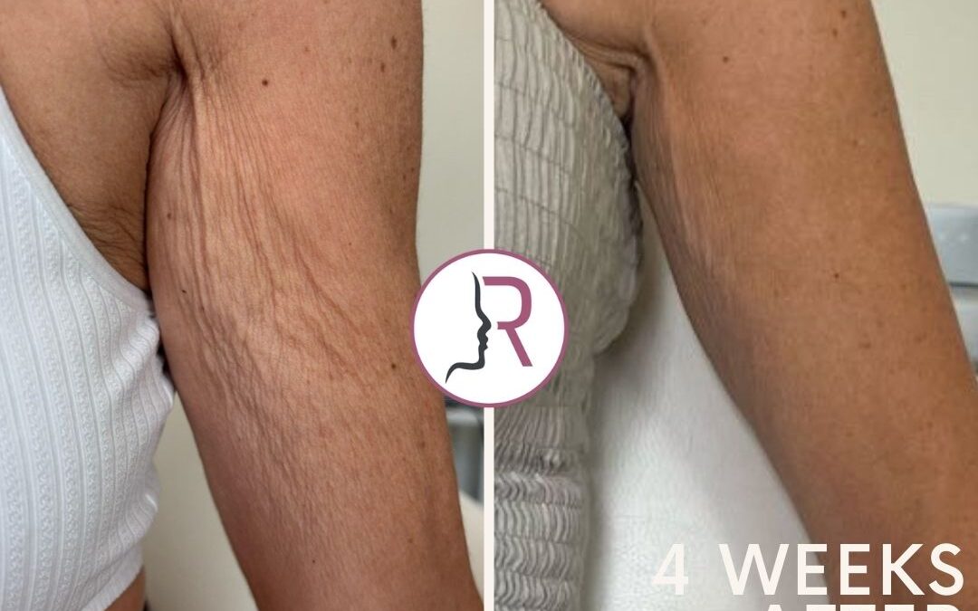 Benefits of thread vein removal that you should consider | Vipon